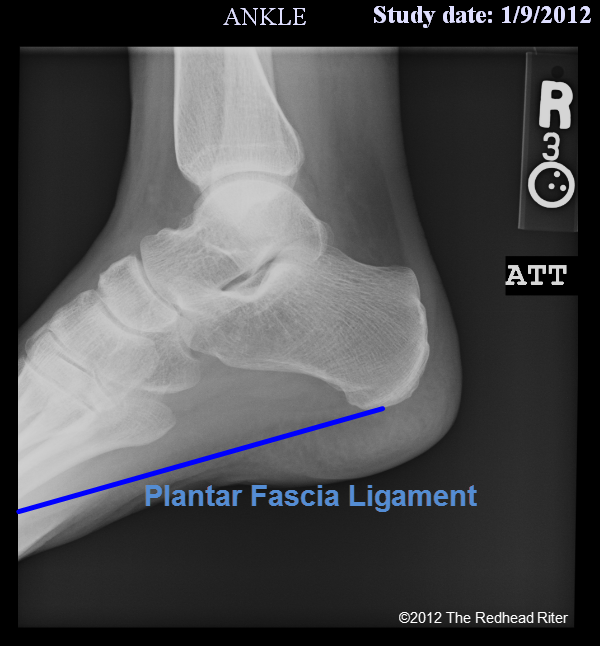 Plantar Fascia Ligament The Naked Truth